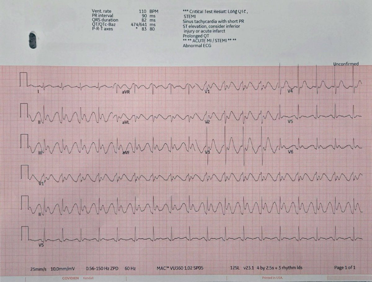 Here’s another interesting one: 40 y/o M, admitted through ER due to N&V after eating seafood and this EKG. Thoughts? #epeeps #epfellows #Cardiology #CardioTwitter