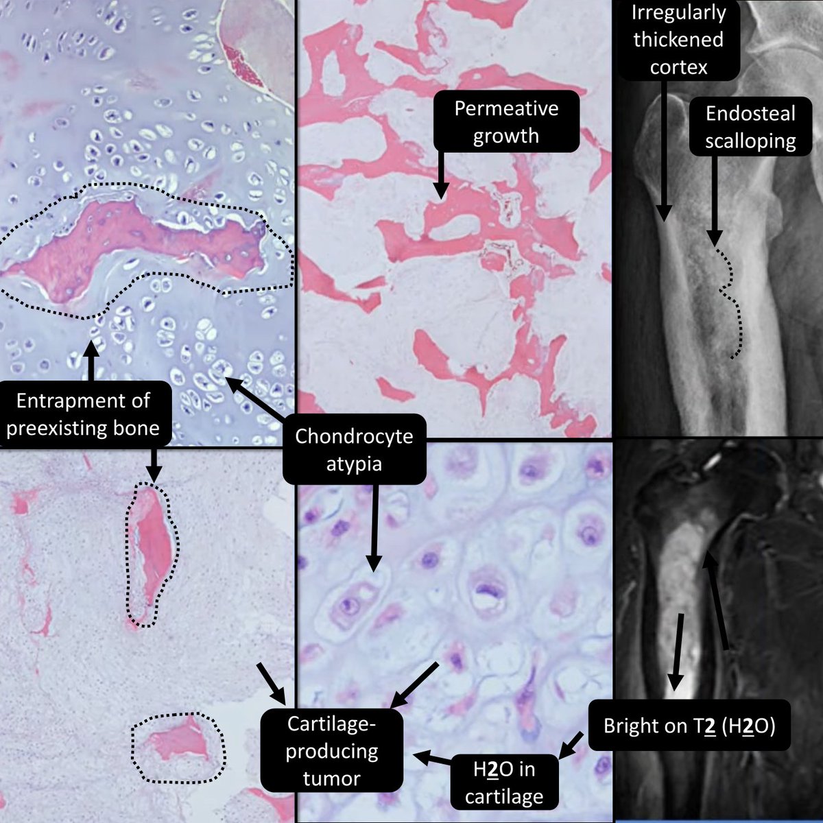 DrCycloPath's tweet photo. ___ favor chondrosarcoma (over enchondroma)
A) myxoid degeneration
B) erosion &amp; entrapment of bone
C) tendency for axial skeleton
D) all of the above
🖼️🙏Dr Roberto Garcia PathCast https://t.co/i09zVcvqvj 
#BSTPath #PathResidents #PathTwitter https://t.co/bd86O5fgBJ