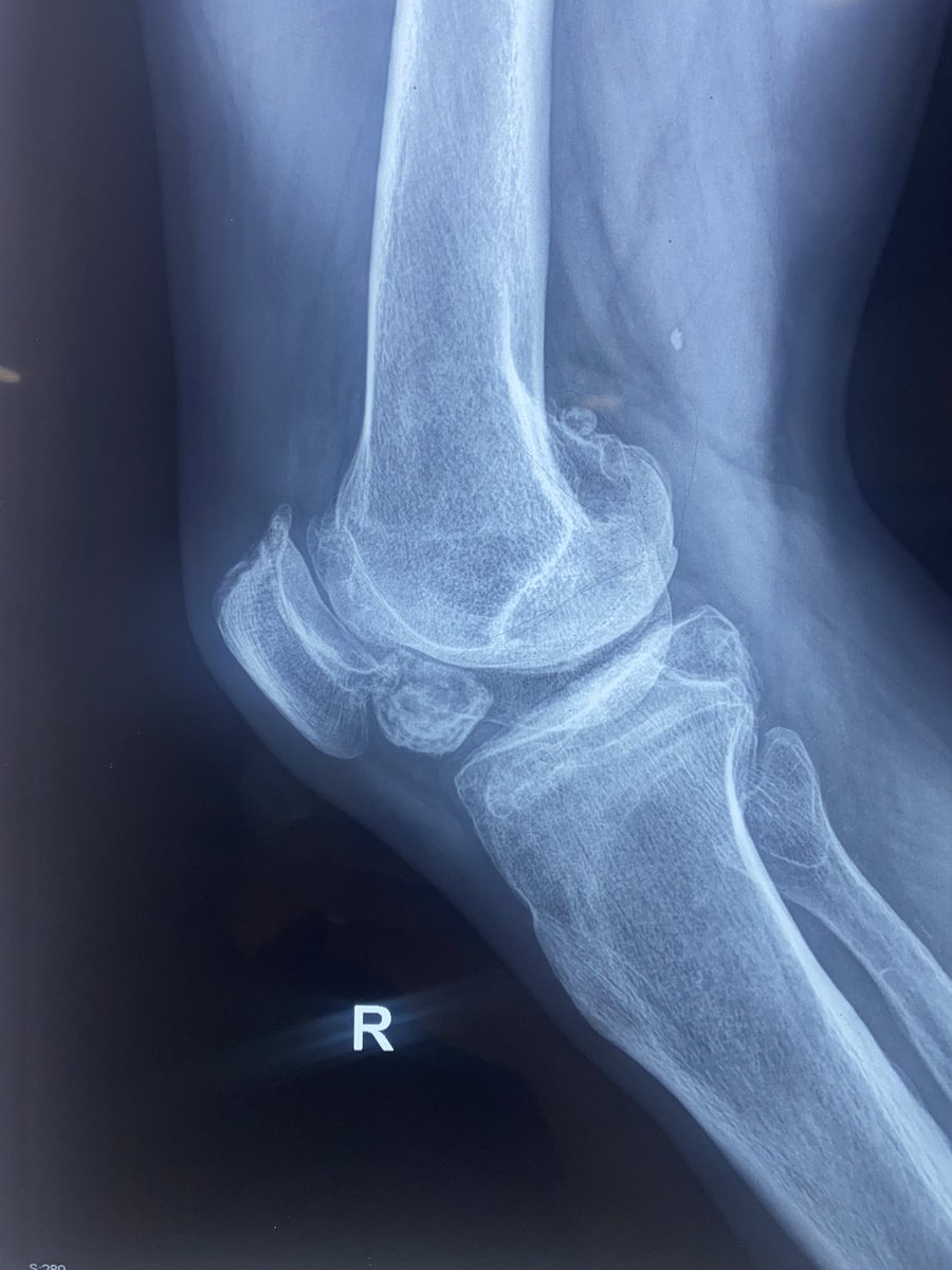 Rodillascirugia's tweet photo. Extracción de osteofito gigante https://t.co/70J1YaZlrE