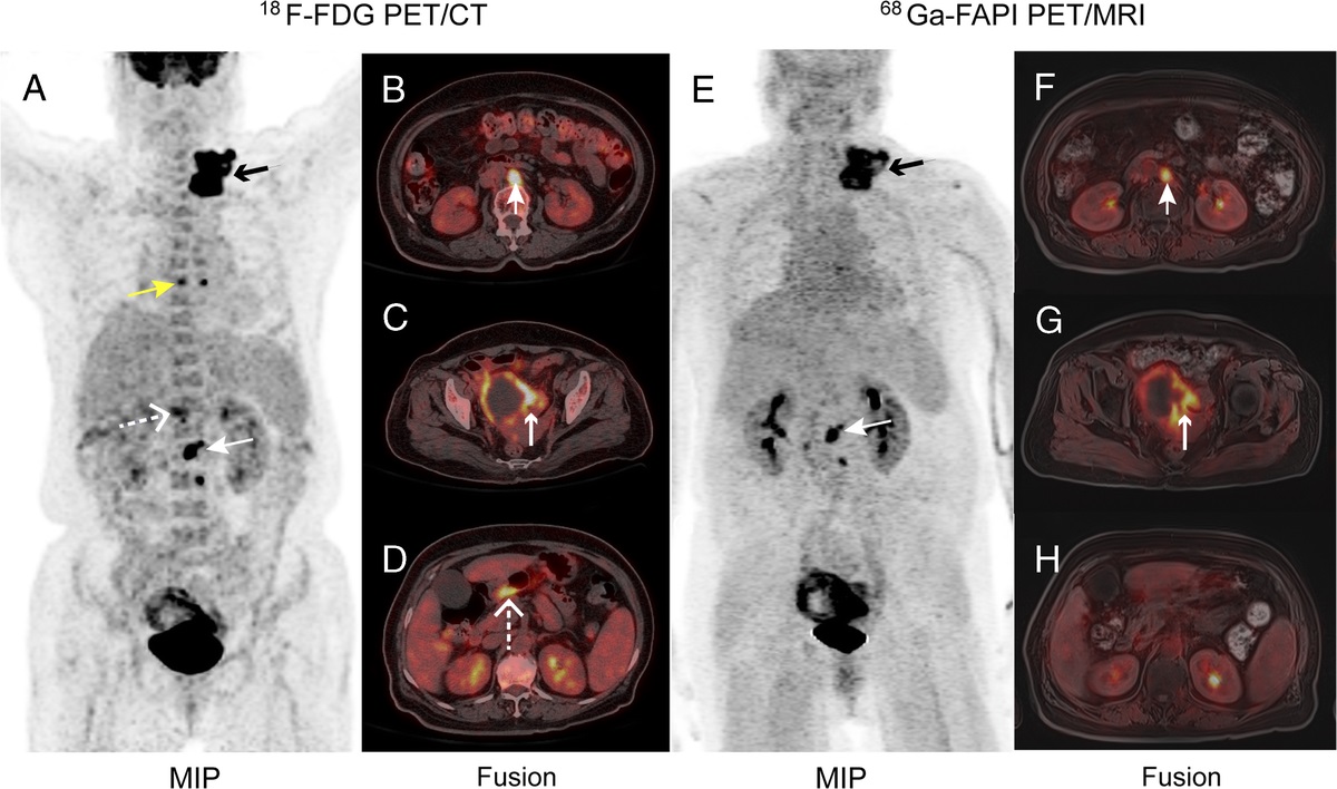 Current Issue: 68Ga-FAPI-04 PET/MR Versus 18F-FDG PET/CT in the Detection of Ovarian Cancer dlvr.it/T4HjK8