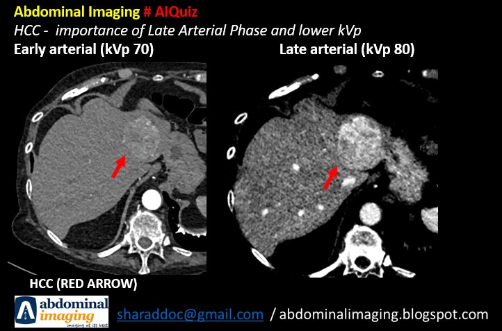 Abdominal imaging #AIQuiz 

Imp. of the 'Late Arterial Phase' in a Triphasic CT Scan done to rule out HCC. 

The contrast delivery to liver and hypervascular HCC is enhanced during the 2nd arterial phase. 

cortex.acr.org/RadsPreview/Ca….

#radtwitter #foamrad #FOAMed  @CafeRoentgen