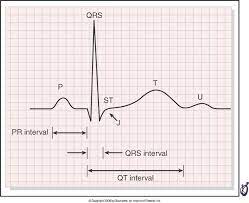 Families: Don't be put off by the title of this paper. Take home message: ECGs are needed to check for Long QT in Rett syndrome and to monitor for intermittent prolonged QT interval which can happen with breathing irregularities. ed.gr/ehavd