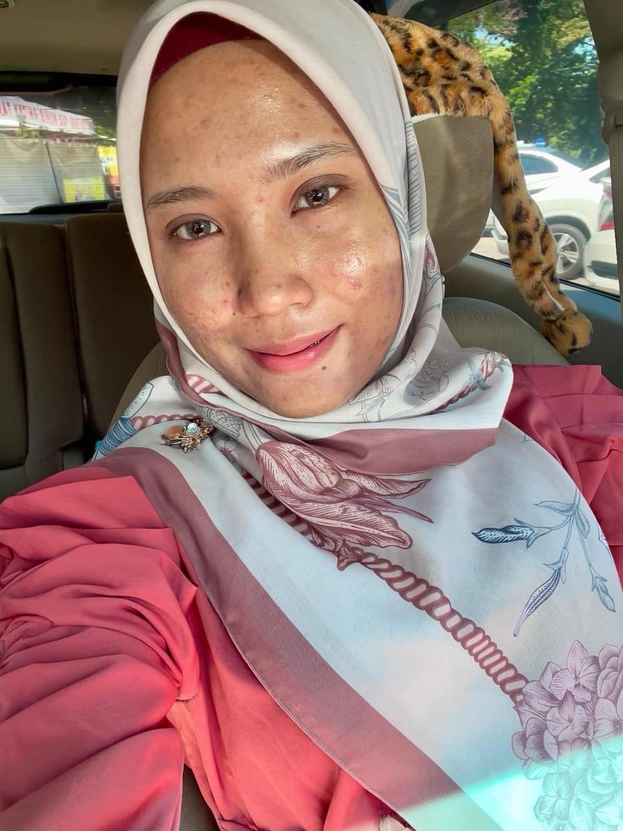 IsafeyBeauty's tweet photo. Muni posted this #beforeandafter 4month transformation with Tretinoin and Azelaic acid

Her skin type: combination/clog prone skin
In October 2023 | try tretinoin 0.05 every night .
Routine on the thread https://t.co/83UULao9jX