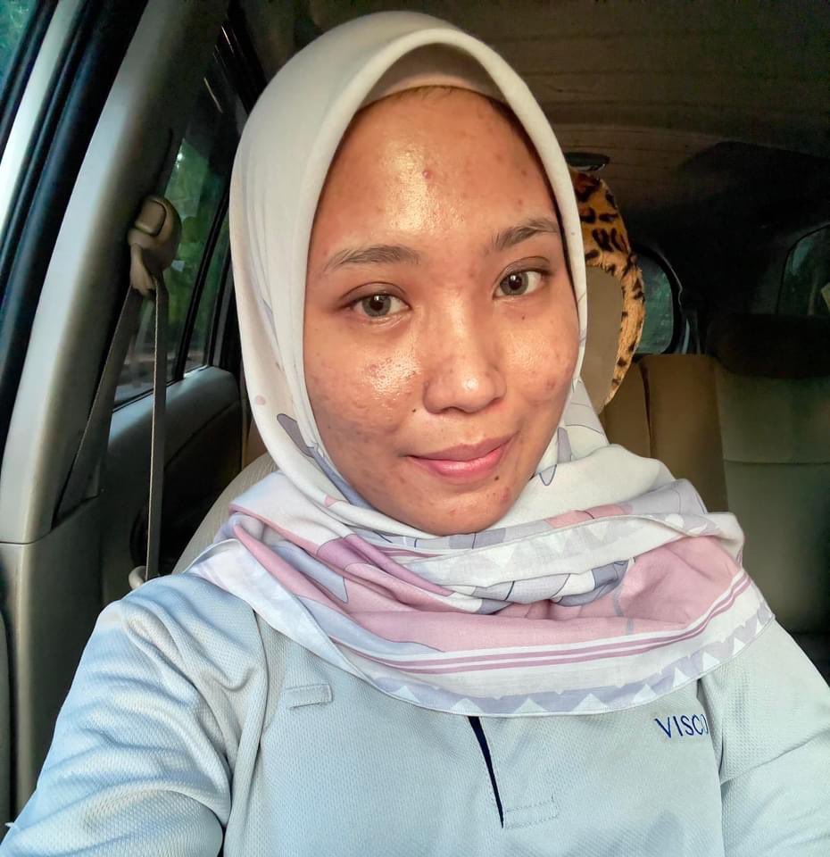 IsafeyBeauty's tweet photo. Muni posted this #beforeandafter 4month transformation with Tretinoin and Azelaic acid

Her skin type: combination/clog prone skin
In October 2023 | try tretinoin 0.05 every night .
Routine on the thread https://t.co/83UULao9jX