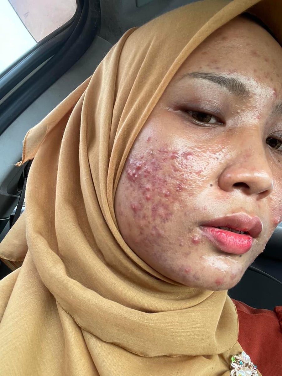 IsafeyBeauty's tweet photo. Muni posted this #beforeandafter 4month transformation with Tretinoin and Azelaic acid

Her skin type: combination/clog prone skin
In October 2023 | try tretinoin 0.05 every night .
Routine on the thread https://t.co/83UULao9jX