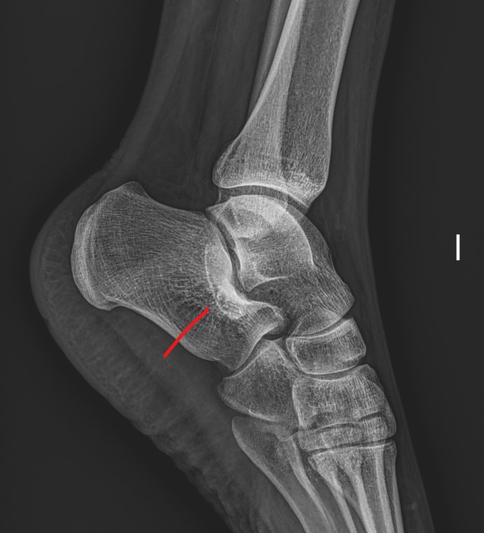 19/3/2024. 🟠 26F with chronic ankle pain aggravated over past year. XRAY hints at underlying pathology; confirmatory #CT/#MRI warranted for definitive diagnosis. #MSK #Radiology #AnklePain