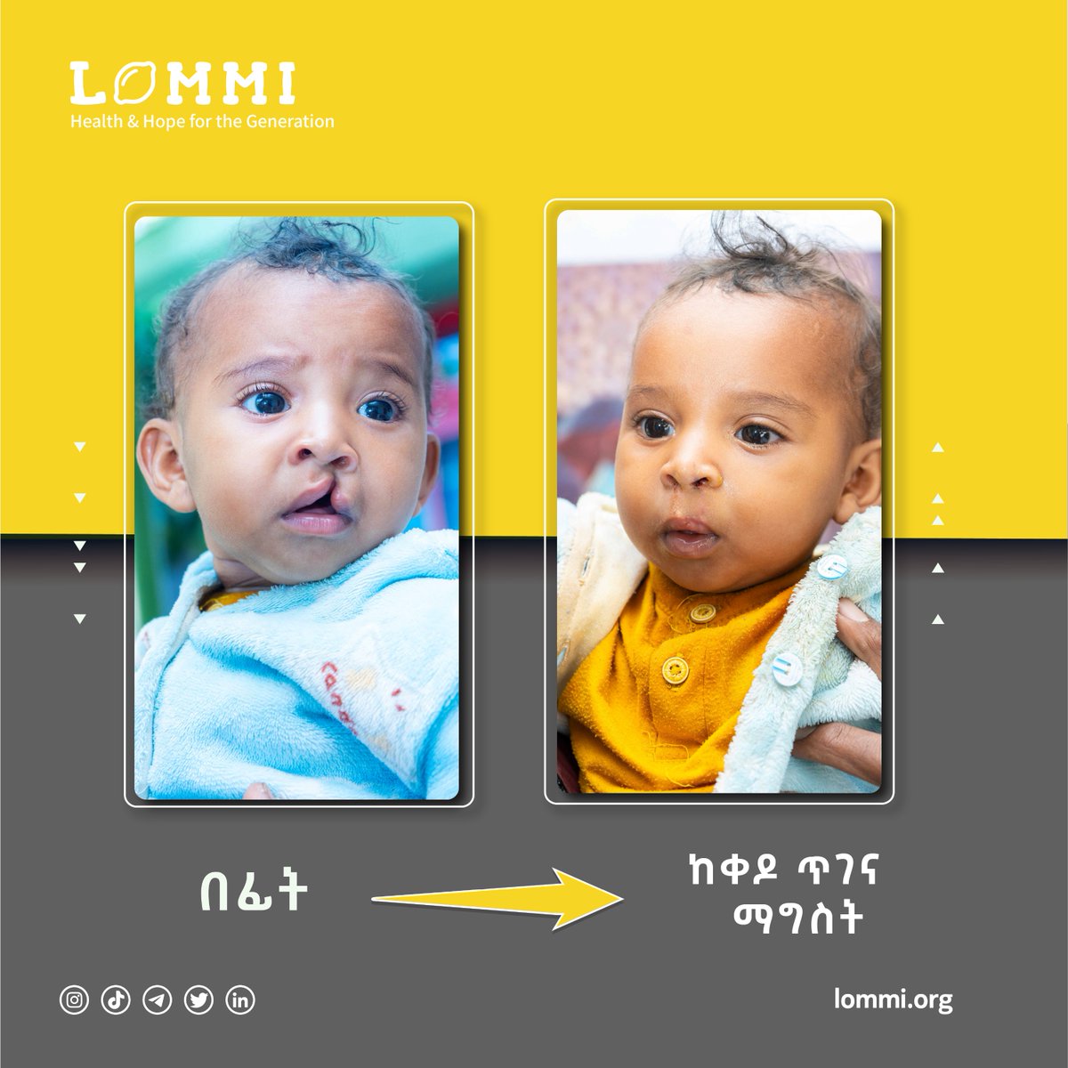 የከንፈር እና የላንቃ መሰንጠቅ ተፈጥሮአዊ ክስተት ሲሆን በህክምና ይስተካከላል።

ለተጨማሪ መረጃ እና ለመመዝገብ
☎️☎️☎️0973025555 ላይ ይደወሉ!

🍋 🍋 🍋
lommi.org