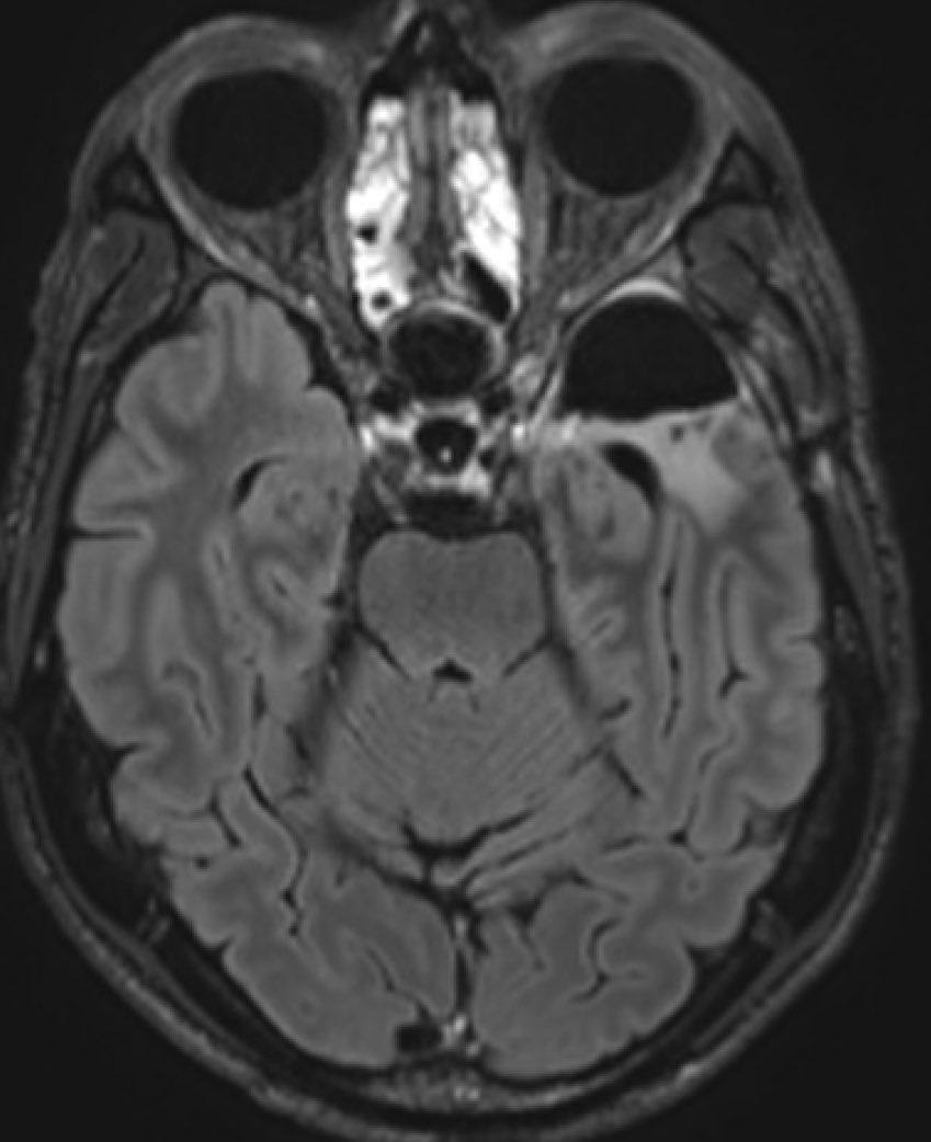Fantastic news!!!!!! Amazingly, my latest MRI brain scan shows no recurrence 10 months since my #glioblastoma presented with a seizure in #Poland. Median time to recurrence is 6 months. I’m extremely hopeful that the novel #neoadjuvant combination #immunotherapy I’ve had &