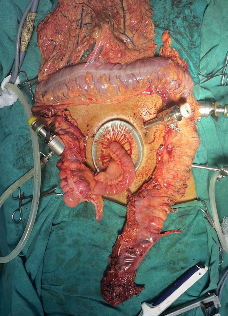 Quite few pancolectomies this month- from refractory colitis to toxic megacolons n transmural necrosis #pancolitis #IBD #IBDSurgery #colectomy #PouchSurgery #IPAA