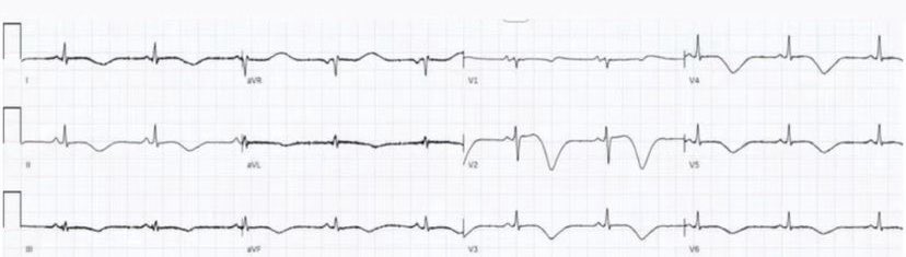 50 year old, recent thyrotoxicosis, with shortness of breath. What do you think? #ECG #EKG #FOAMed #MedEd #CardioEd #CardioTwitter #medicalstudent #MedstudentTwitter #EmergencyMedicine