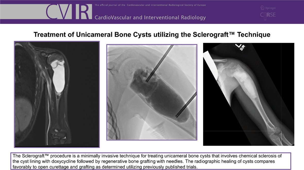 Check out this #clinicalinvestigation 🔍
Treatment of Unicameral Bone Cysts Utilizing the Sclerograft™ Technique
link.springer.com/article/10.100…