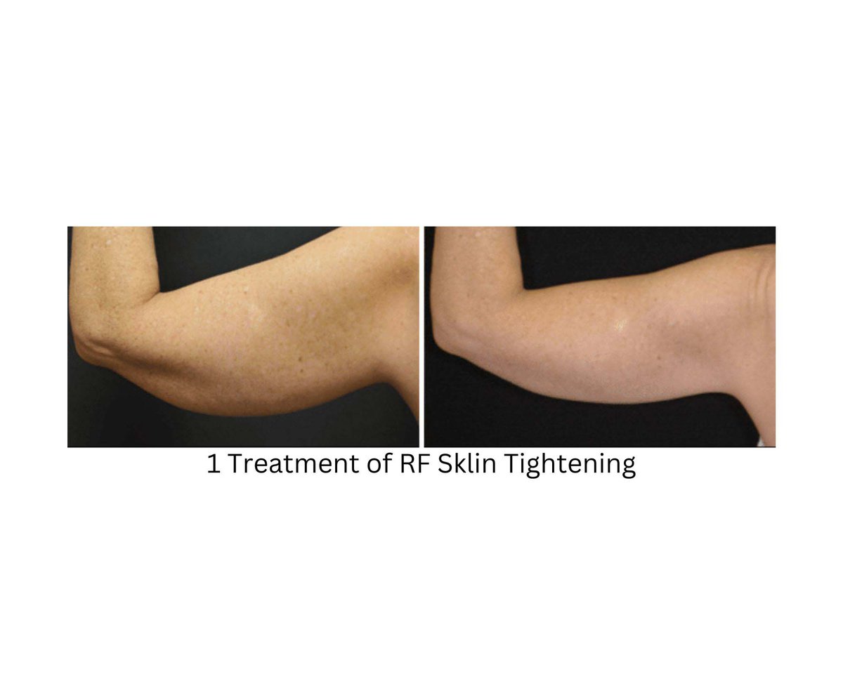 Bougiebodies's tweet image. Here at our day spa, you will experience advanced skin tightening treatments designed to rejuvenate and revitalize your skin. Contact us today at (903) 488-7958 to schedule an appointment!

 #DaySpa #MabankTX
dayspamabank.com/contact