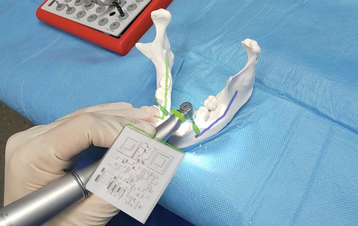 [😎#augmentedreality in #implantology ] ➡️ pubmed.ncbi.nlm.nih.gov/38452901/ A #virtual pedagogical #checklist for dental #implant surgical protocol with an #AR guided #surgery to inexperienced surgeons using a head mounted display with tracking. @nobelbiocare @CHU_Lille @univ_lille