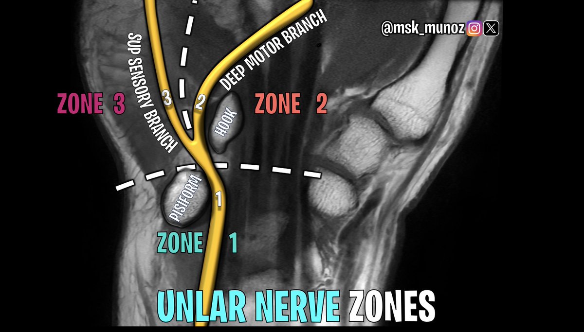UNLNAR NERVE ZONES, HAND

Compression Sites:

• Zone 1: motor + sensory ( hook fx and ganglion) 
• Zone 2:  deep motor branch, motor symptoms (hook fx and ganglion) 
• Zone 3:  superficial sensory branch, sensory symptoms (aneurysm or thrombosis)

#ulnarnerve