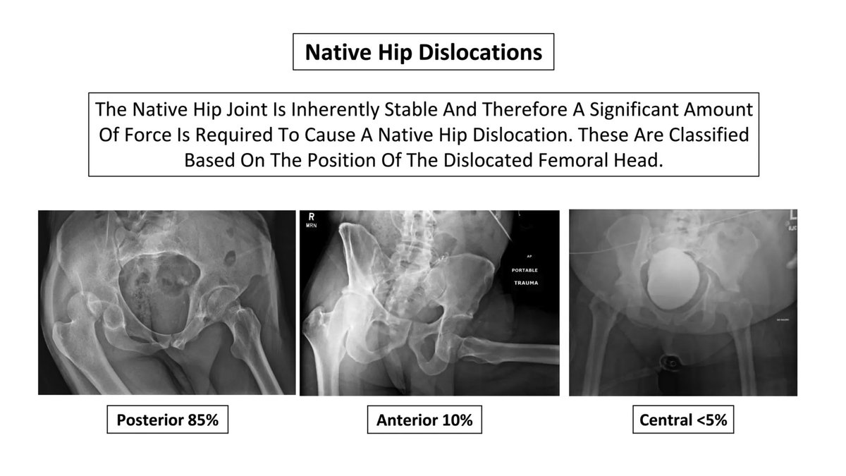 Dive into our latest series on Adult Orthopedic X-Ray Cases focusing on Native Hip Dislocations, curated by experts in the field. #MedEd #MedTwitter #FOAMed #Radiology litfl.com/adult-ortho-ca…