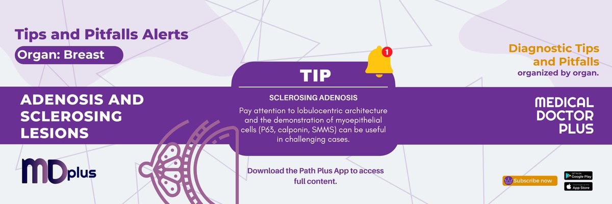 MDplusApp's tweet photo. This is the most common form of mammary adenosis, a condition in which there is abnormal growth of glandular tissue. In many cases, there may be multiple proliferative lesions, making it difficult to distinguish from invasive carcinoma. 

#pathology  #medicine #mdplus https://t.co/9qcxHWrbcS