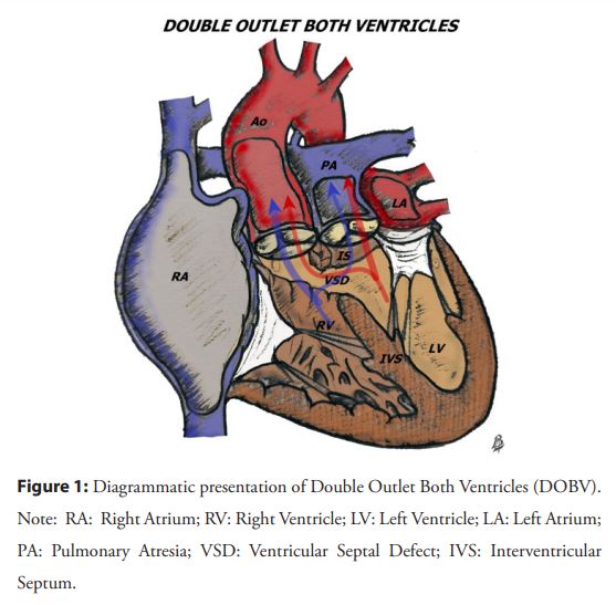 Double outlet both ventricles: An overview Read the full article: openaccessjournals.com/articles/doubl… Thank you, Dr. Maruti Haranal, for providing the excellent article to our journal. #CardioTwitter #MedTwitter #Cardiology #medicine #Pocus #heart #heartbeat #valves