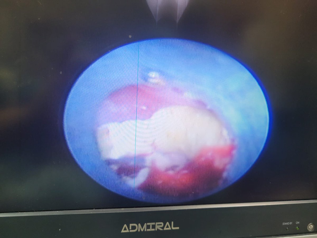 ❇️ Old school Pass me the Ball ❇️
#ambulatoryPCNL #daycare #endourology #pcnl