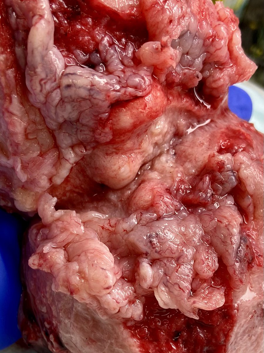 POV: you receive a #uterus with clinical hx of “abnormal uterine bleeding”, and this is what you find upon opening it. What are your first thoughts?? #pathtwitter #MedTwitter #pathology #pathresidents #pathassist #gynpath