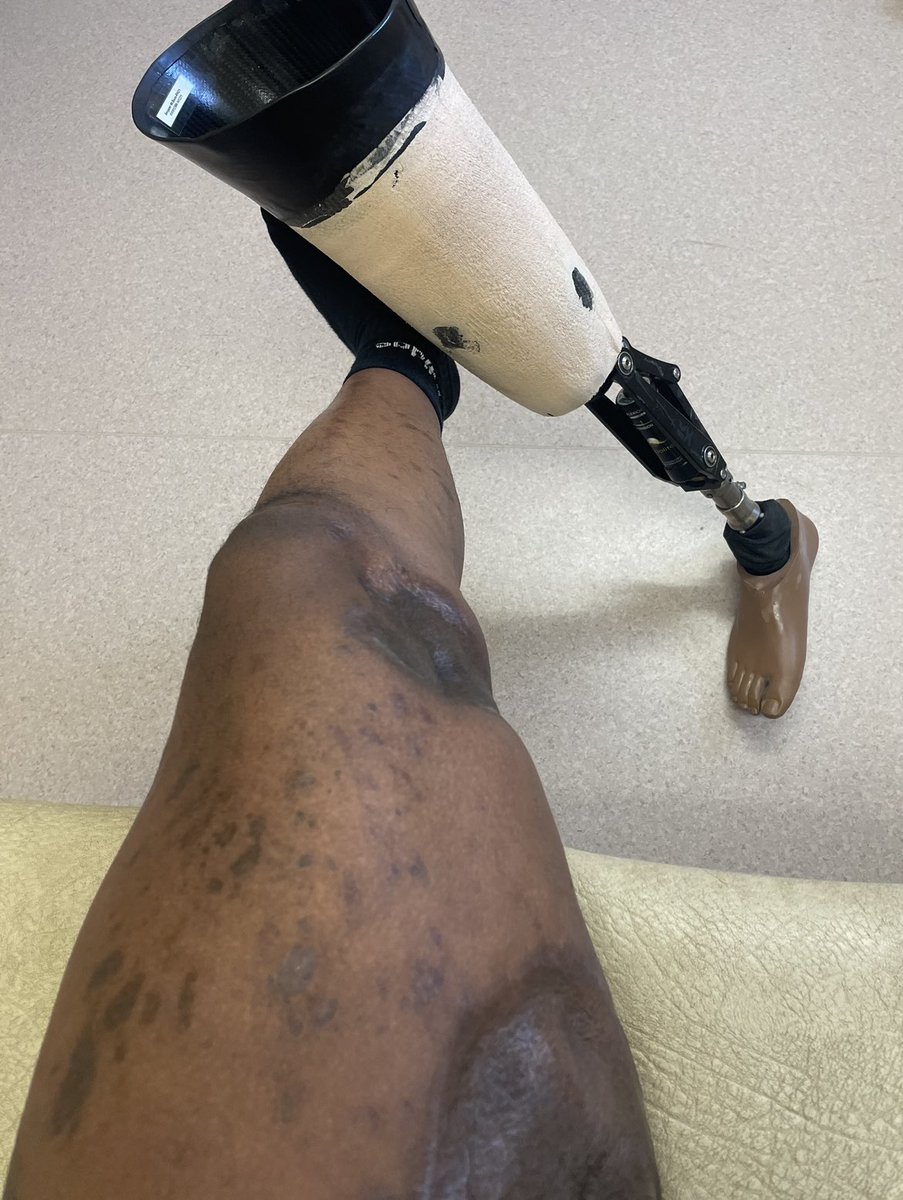 benmcbean's tweet image. New one on order! Hopefully it’ll hold me up a bit better after a few beers.
Little dark spots are shrapnel, large marks, shrapnel and burns if your wondering. I got smashed up. 🫡
#keepitmoving 
#veteran 
#amputee 
#prosthetics