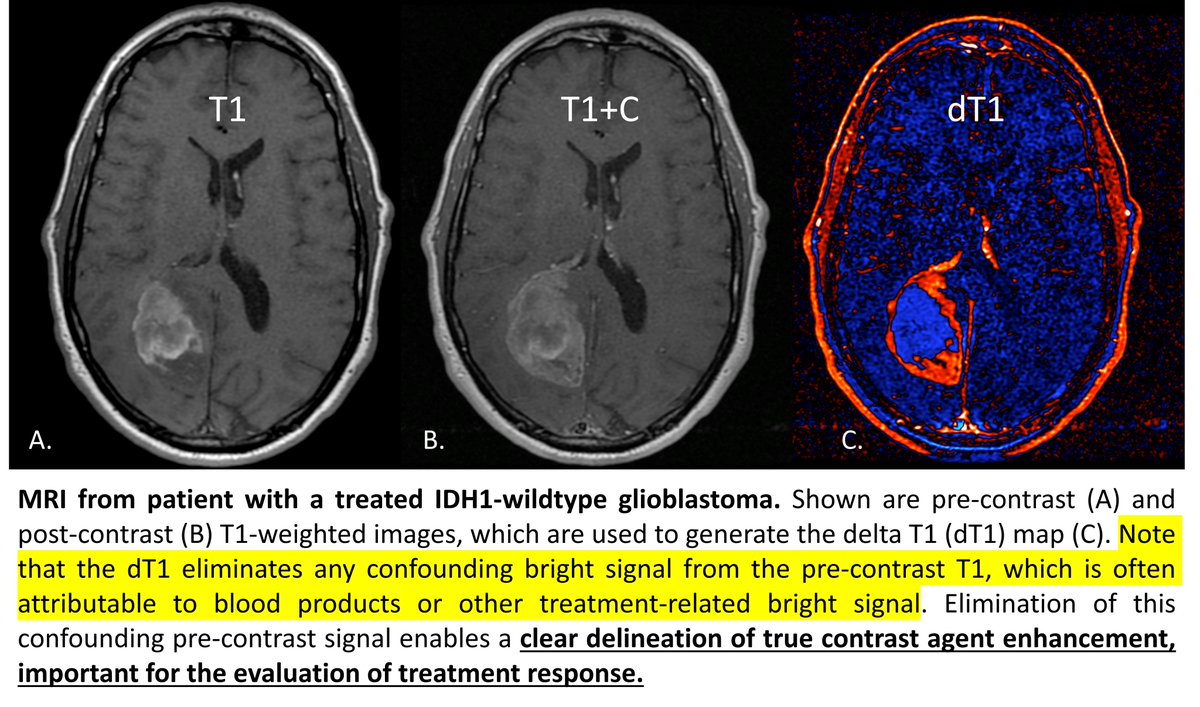 The ability to reliably make this distinction is critical in brain tumor management. Standard MRI (left 2 images) cannot reliably distinguish treated brain tumor from non tumor treated tissue. Delta T1 maps (patent-pending & automated) tell the story.
@TheASNR @theASFNR @NeuroOnc