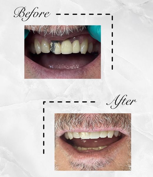 promenadecenter's tweet photo. Broken bridge? No problem! This pt came in due to a broken bridge that was done years ago. Dr. Alina did this beautiful restoration &amp; brought his confidence 📷
#promenadecenterfordentistry #teamwork #teeth #dentaloffice #cltdentist #dentistry #brokendentalbridges #dentalbridges https://t.co/krcoUt2sxE
