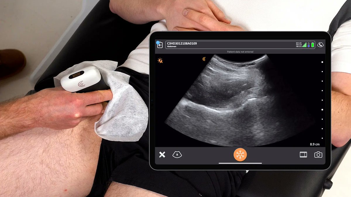 Thinking of upgrading your POCUS system to best-in-class? Currently offering significant savings for clinicians who use any other brand of device to upgrade to the Clarius HD3 line. Quantities are limited, so contact us today to get more details #ultrasound #msk