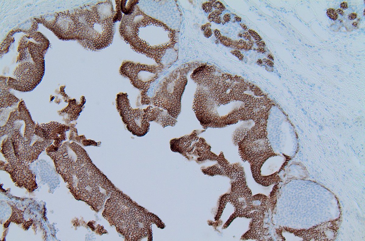 When DCIS and LCIS wanted to go hand in hand 🤝 with E-cadherin #breastpath