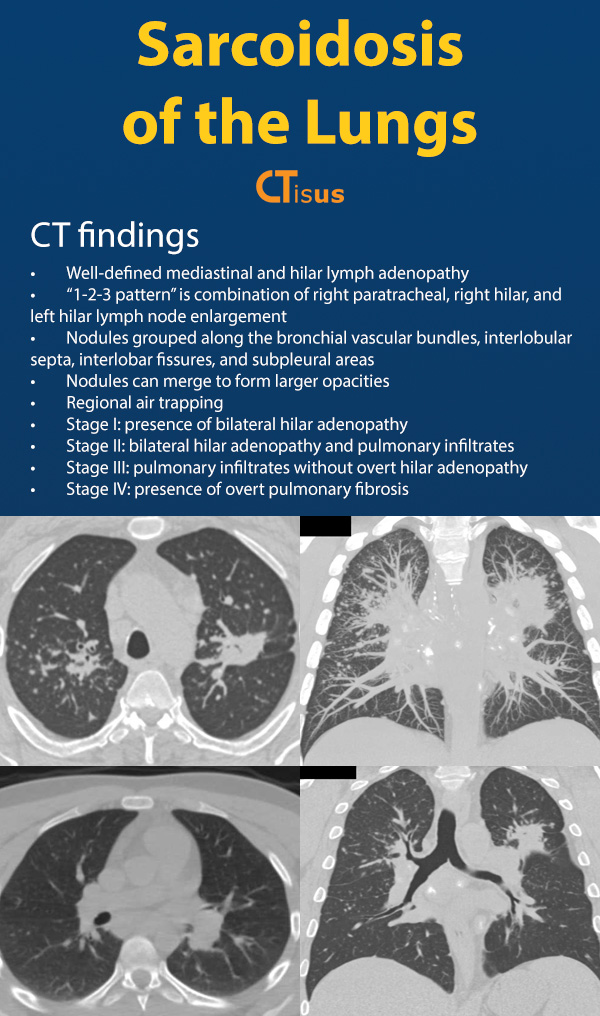 Sarcoidosis of the Lungs: CT Findings