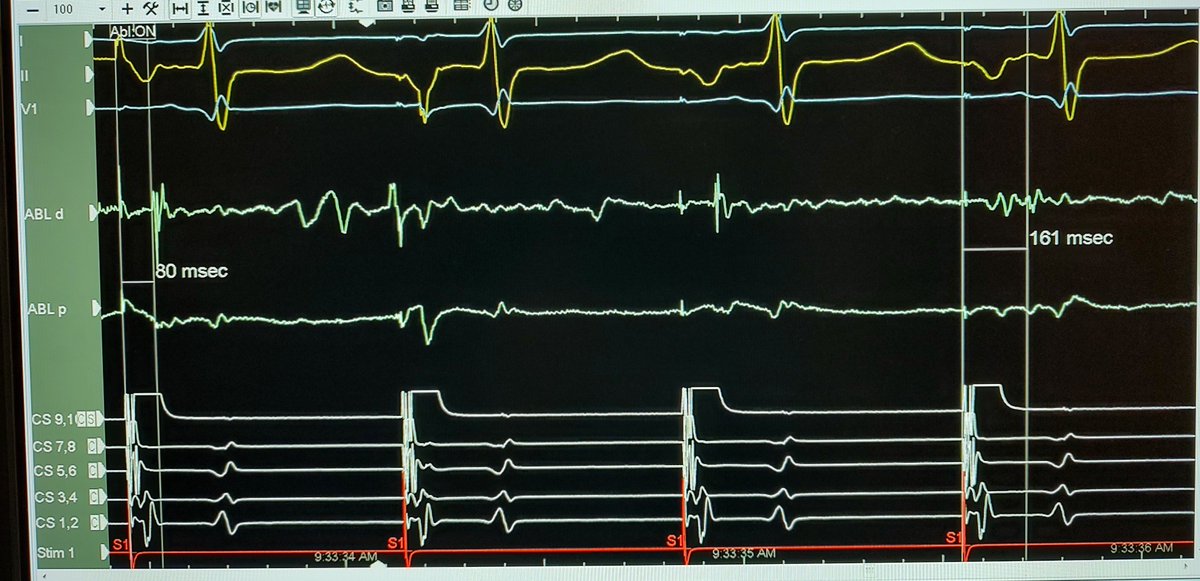 Great P wave physiology during flutter ablation (with CS pacing).
1. P wave before &amp; after CTI ablation (late component gets later, becomes positive in 2,3,F)
2. Correlates with stim-lat isthmus egm timing
3. Transition during RF at time of CTI block (with P wave change)