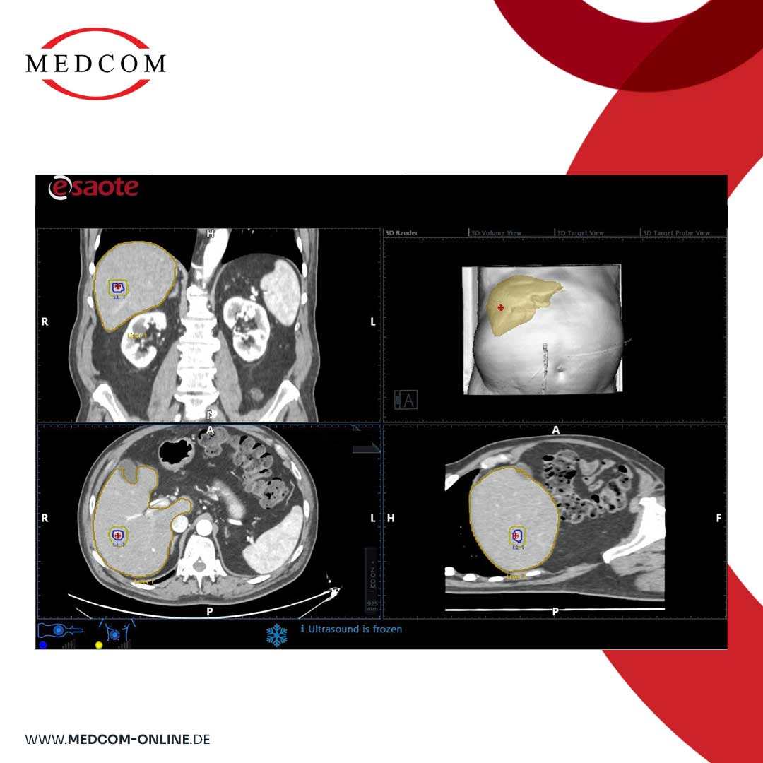 📢 Introducing NaviSuite® from #MedComGmbH! 🚀 Our latest innovation, a new Liver modality, revolutionizes pre-post data comparison for enhanced medical outcomes. 💙 Discover how #NaviSuite® improves workflow, identifies liver lesions, &amp; enhances interventional imaging
 #Liver