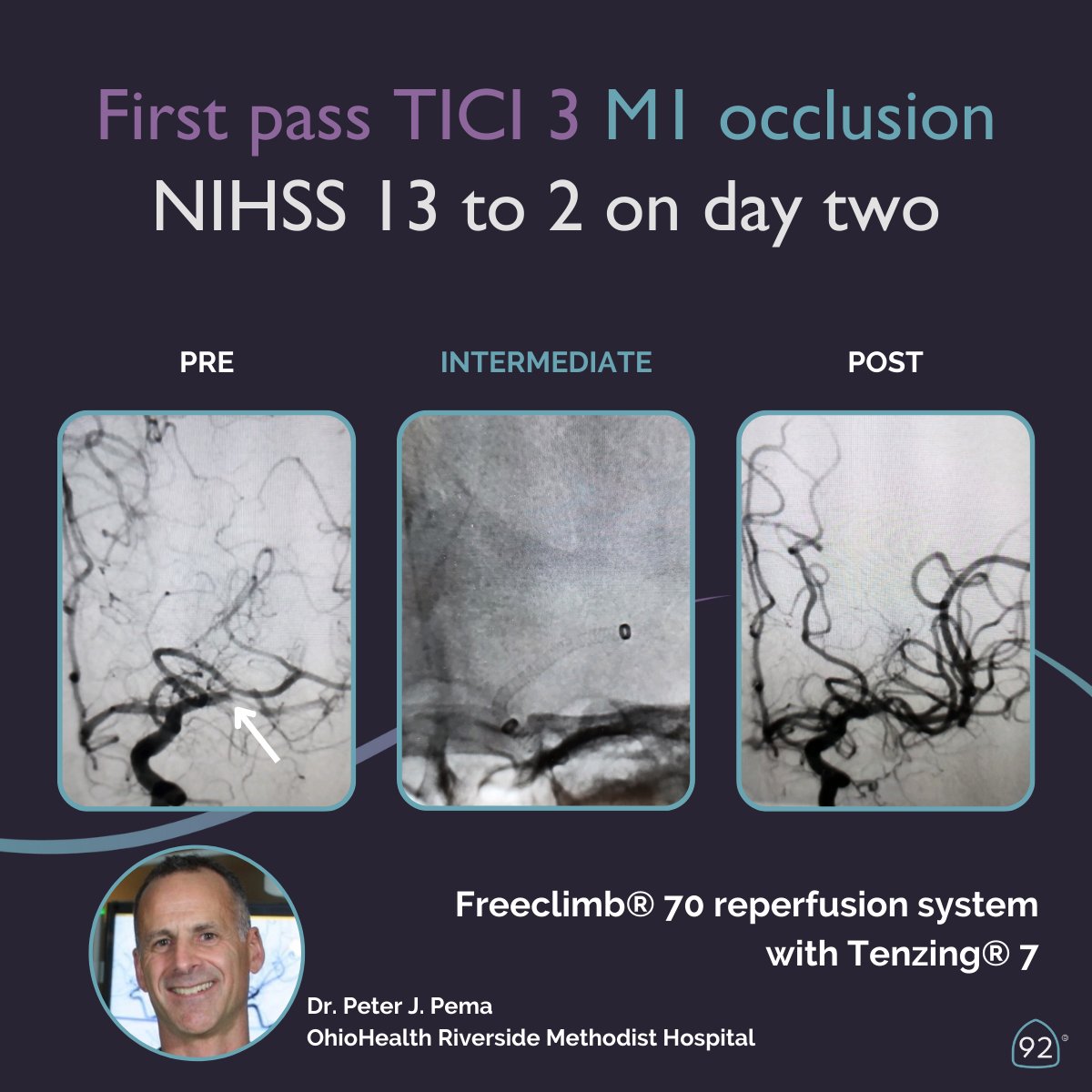 Thank you & congratulations to Dr. Peter J. Pema and the team at OhioHealth Riverside Methodist Hospital for sharing this successful M1 case using the #FreeClimb70 reperfusion system. No MC or guidewire was necessary when using #Tenzing7 on this first pass TICI 3 case.