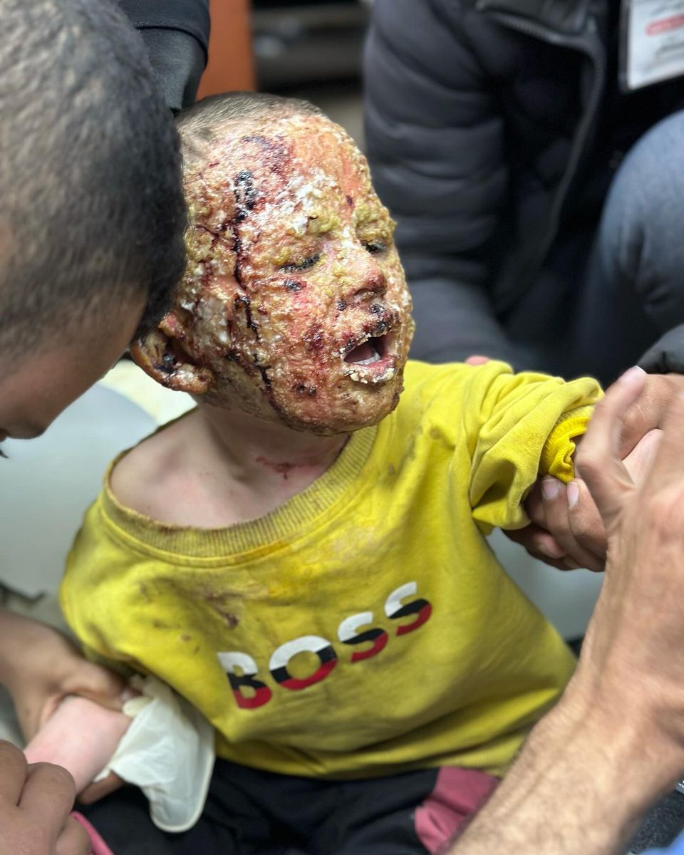 DaniMayakovski's tweet photo. Esta es Saja Junaid, una niña palestina de 7 años, primero fue bombardeada por los sionistas con fósforo blanco en el norte de Gaza y estando gravemente herida, ahora los sionistas la expulsan del hospital Al-Shifa junto a su padre.

Es el rostro de la barbarie sionista en Gaza. https://t.co/BtGtM842br