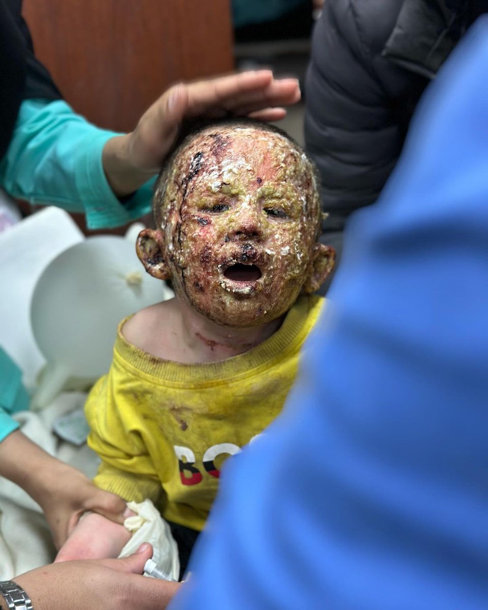 DaniMayakovski's tweet photo. Esta es Saja Junaid, una niña palestina de 7 años, primero fue bombardeada por los sionistas con fósforo blanco en el norte de Gaza y estando gravemente herida, ahora los sionistas la expulsan del hospital Al-Shifa junto a su padre.

Es el rostro de la barbarie sionista en Gaza. https://t.co/BtGtM842br