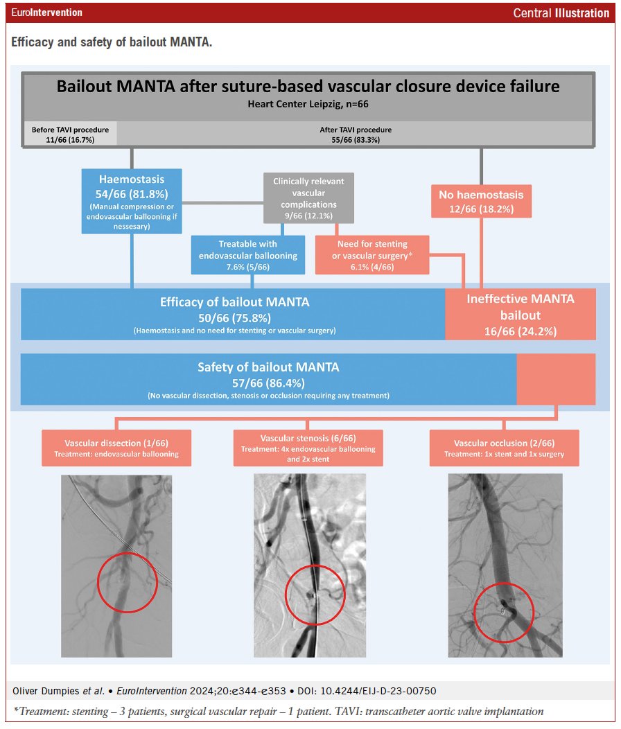 'There are limited options for suture-based vascular closure device (VCD) failure after transfemoral TAVI. Anecdotally, the plug-based MANTA VCD has been suggested as a bailout device. Bailout MANTA after suture-based VCD failure was effective and safe in this study, but operator