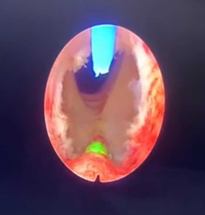 AlejandroGoDiaz's tweet photo. It’s been a pleasure to try the @IzasaMedical #slimHoLEP 22Ch (#MiLEP) with 7 cases yesterday and today. For this short but intense experience I can say it’s feasible to use it w/ prostates up to 100cc, anticoagulated patients or the ones w/ previous #BPH surgery @PolicliGipuzkoa https://t.co/QiYzWrTM7q