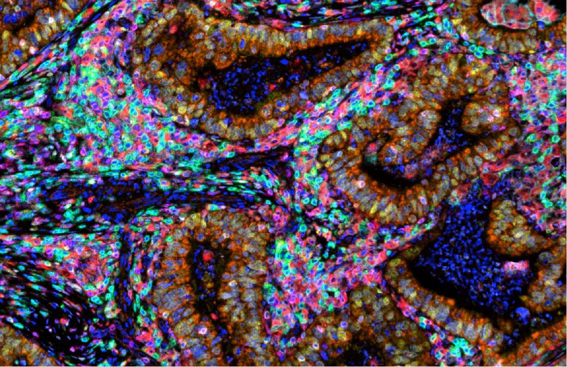 #ColorectalCancer (CRC) is the second deadliest cancer in the United States; however, it is highly preventable with screening. 

For today's #TissueTuesday, we're featuring an impressive colorectal cancer image surrounded by immune cells. The tissue was imaged with #PhenoImagerHT