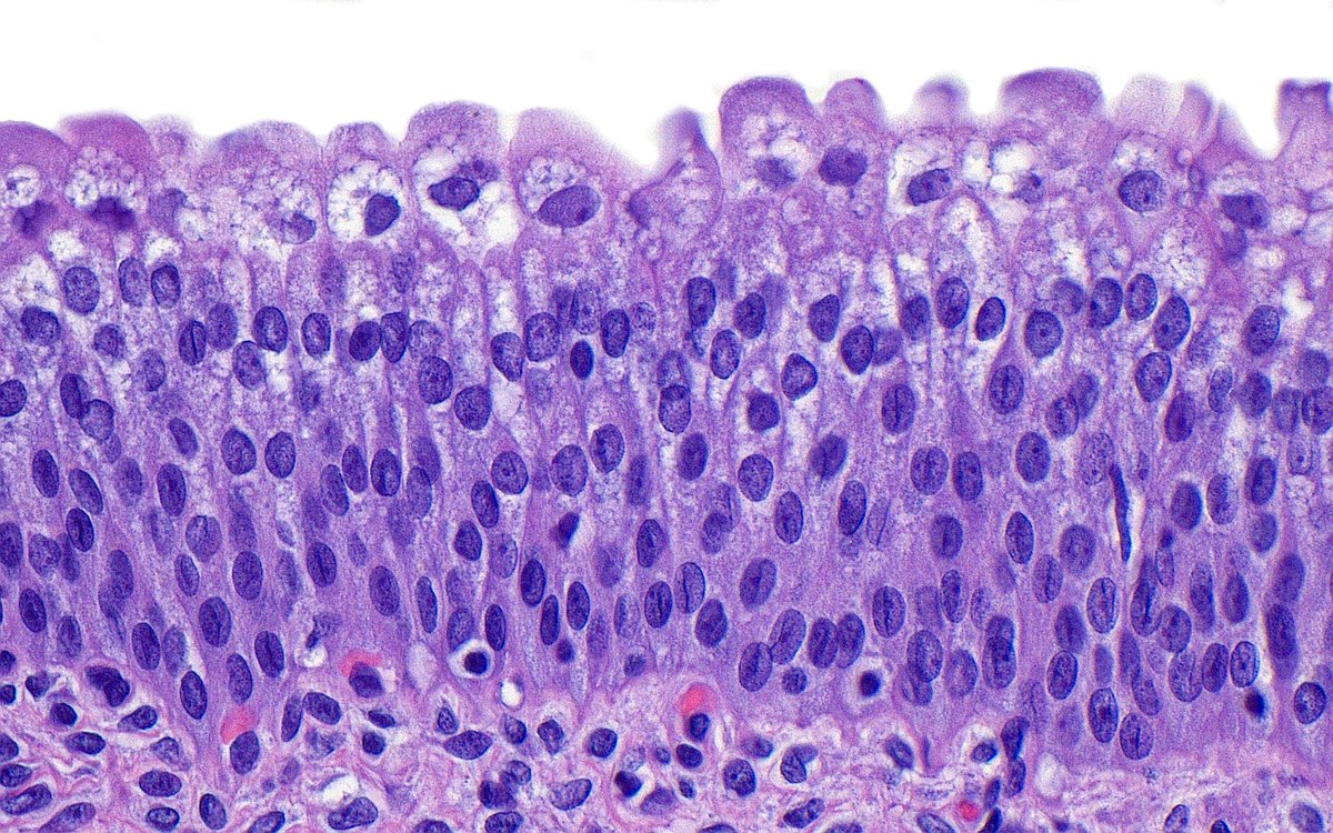 Urothelium ~ #GUpath #histology #PathArt