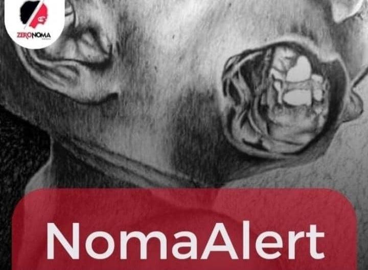 ZeronomaAfrica's tweet photo. We raise a #NomaAlert when a #noma case is seen at any stage of the disease. 

In the last 5 days, we have been seeing cases daily, many thanks to our #volunteers creating the awareness and our #partners for the support.

@Fmohnigeria 
@mathiswinkler 
#BeatNTDs 
#Zeronoma https://t.co/iSOcgg4KQU