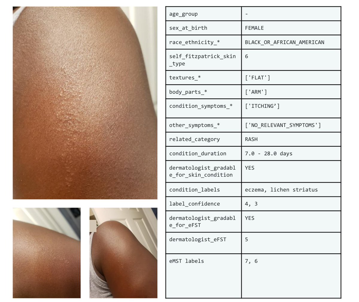 Google AI (@googleai) on Twitter photo Today we release the Skin Condition Image Network (SCIN) dataset in collaboration with physicians <a href="/StanfordMed/">Stanford Medicine</a>. Designed to reflect the broad range of conditions searched for online, it’s freely available as a resource for researchers, educators, & devs →goo.gle/4amfMwW Today we release the Skin Condition Image Network (SCIN) dataset in collaboration with physicians <a href="/StanfordMed/">Stanford Medicine</a>. Designed to reflect the broad range of conditions searched for online, it’s freely available as a resource for researchers, educators, & devs →goo.gle/4amfMwW