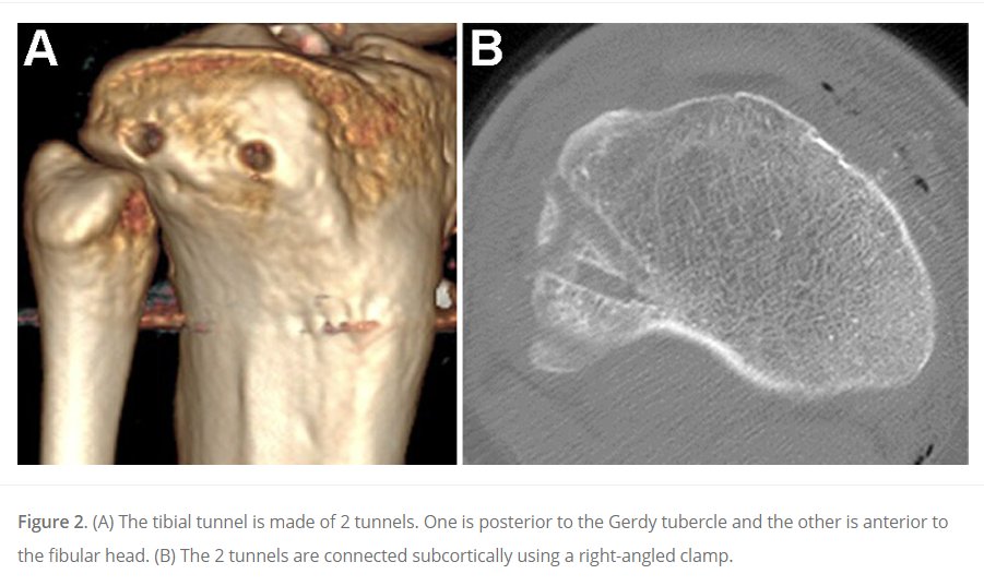 Combined ACLR and ALLR in young women with a high-grade pivot shift was associated with better knee stability parameters, dynamic postural stability, and psychological readiness to RTS than isolated #ACLR. Discover the details #OpenAccess here! ow.ly/C0q550QNKkE