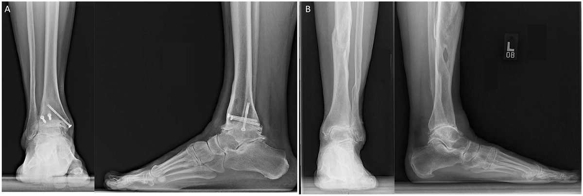 Similar patient reported outcome scores were found in patients following TAA for both primary and posttraumatic ankle arthritis. Does the type of ankle fracture, intraarticular vs extraarticular, matter much? 

Read in FAI: doi.org/10.1177/107110…