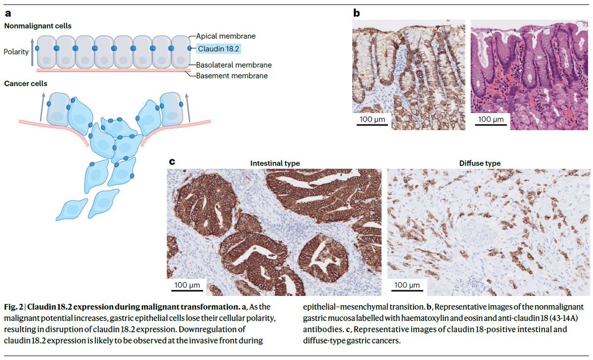 NatRevClinOncol's tweet photo. In a new Review, Izuma Nakayama, Changsong Qi, Yang Chen, Yoshiaki Nakamura, Lin Shen & Kohei Shitara discuss Claudin 18.2 as a novel target for cancer therapy: https://t.co/AHL5heVs6K https://t.co/8sVkR2wnT7