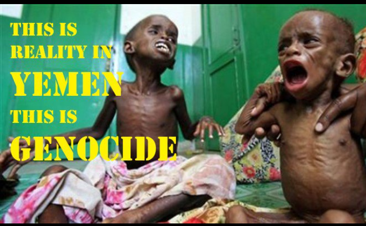 #18MartÇanakkaleZaferi gaza diye ağlayanlar Yemen'de ki çocuklar bombalaniyor Yemen 8 yıldır böyle ! Neredesiniz #Arableague #Oic? 
#Gaza #NeverForget  #YemenCanWait #cholera #StopArmingSaudi #YemeniLivesMatter #YemenCrisis 
#SaveYemen 🇾🇪
#ChildrenUnderAttack
#EndYemenSiege
