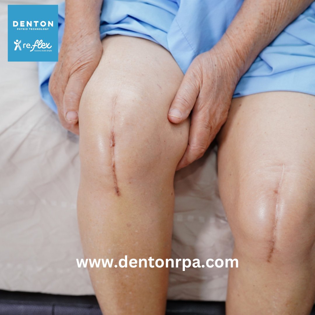 DentonPhysioTec's tweet image. Get in touch today to see how we can help you get the most out of your knee replacement. #rehab #physio #nhs #orthopaedics #kneepain #oaknee