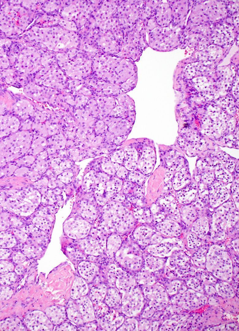 Classic pattern in pathology (with a fun name!). What is this called? What tumors have it? 
Answer &amp; more pics: kikoxp.com/posts/15107
Video: kikoxp.com/posts/15033
#BSTpath #pathologists #pathology #pathTwitter #ENTpath #GUpath #USMLE