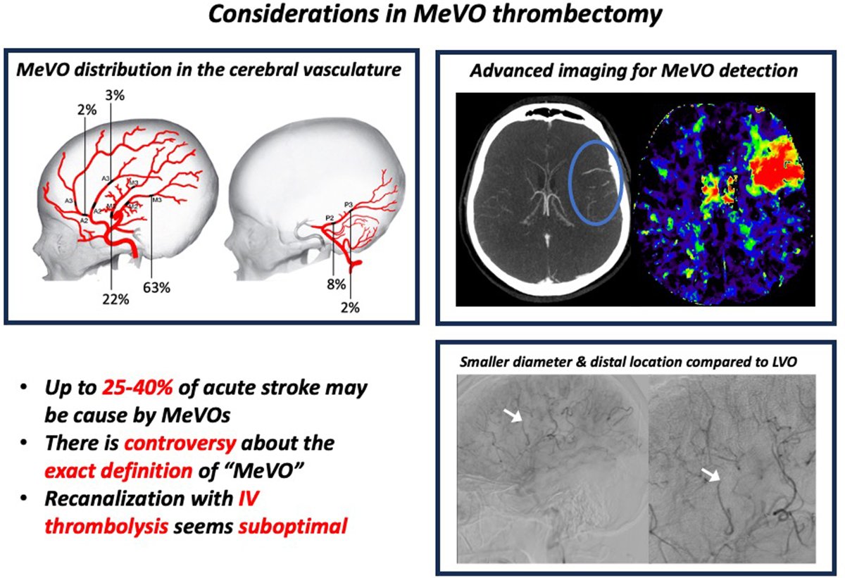 #STROKE Topical Review by @johanna_ospel et al. appraises the state of the science on treatment of stroke caused by medium vessel occlusions and summarizes active areas of inquiry in the field. #AHAJournals ahajournals.org/doi/10.1161/ST… @NguyenThanhMD @MPeyT1 @AshuPJadhav @mayank_G0