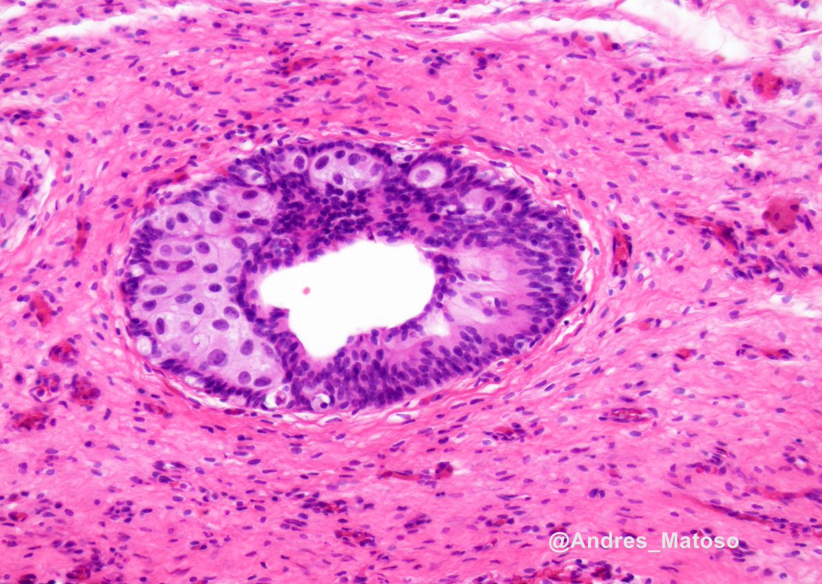 Urothelial carcinoma in-situ (CIS) can be challenging to identify when cells have abundant cytoplasm. In this case of malignant cells spread into cystitis cystica, the sharp contrast with background benign normal urothelial cells is helpful. #gupath