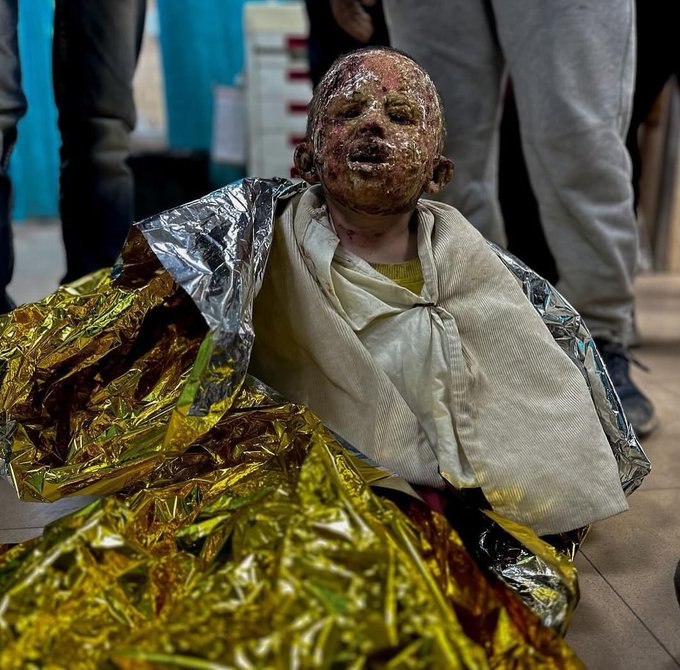 Israel la abrasó viva con el fósforo de sus bombas y ahora la echa del hospital donde la atendían, la deja a su suerte bajo las balas y bombardeos, sin tratamiento, sin comida, sin agua, se llama Saja y tiene 7 años.
Recuérdala cuando los sionazis escupan que Hamás quema niños...