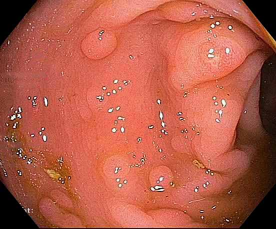 Colonic ganglioneuromas are often a component of the polyposis in patients with the PTEN hamartoma (Cowden) syndrome. These patients have skin lesions (facial trichilemmoma, acral keratoses, papillomatous papules) can develop malignancies (esp. of breast, thyroid). #umiamipath